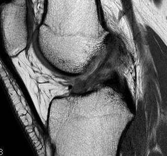 ACL Partial Tear